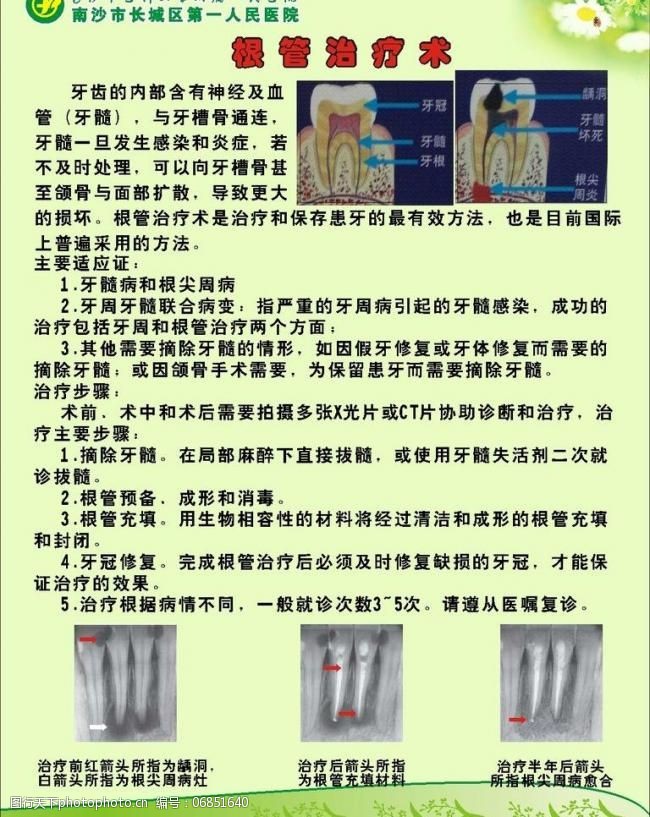 根管治疗术图片