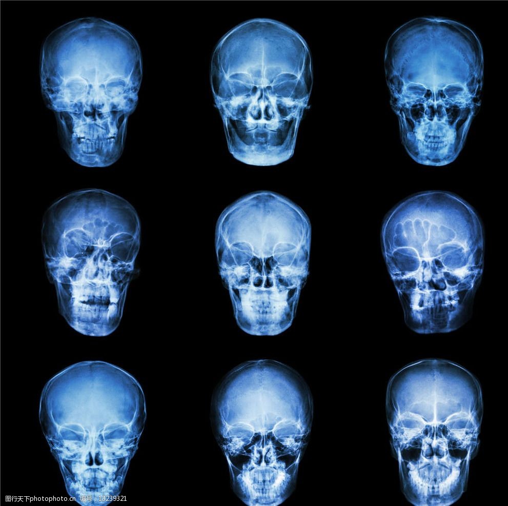 关键词:大脑x光片 大脑 头部 x光 透视 医疗 ct x光片 核磁共振 医疗