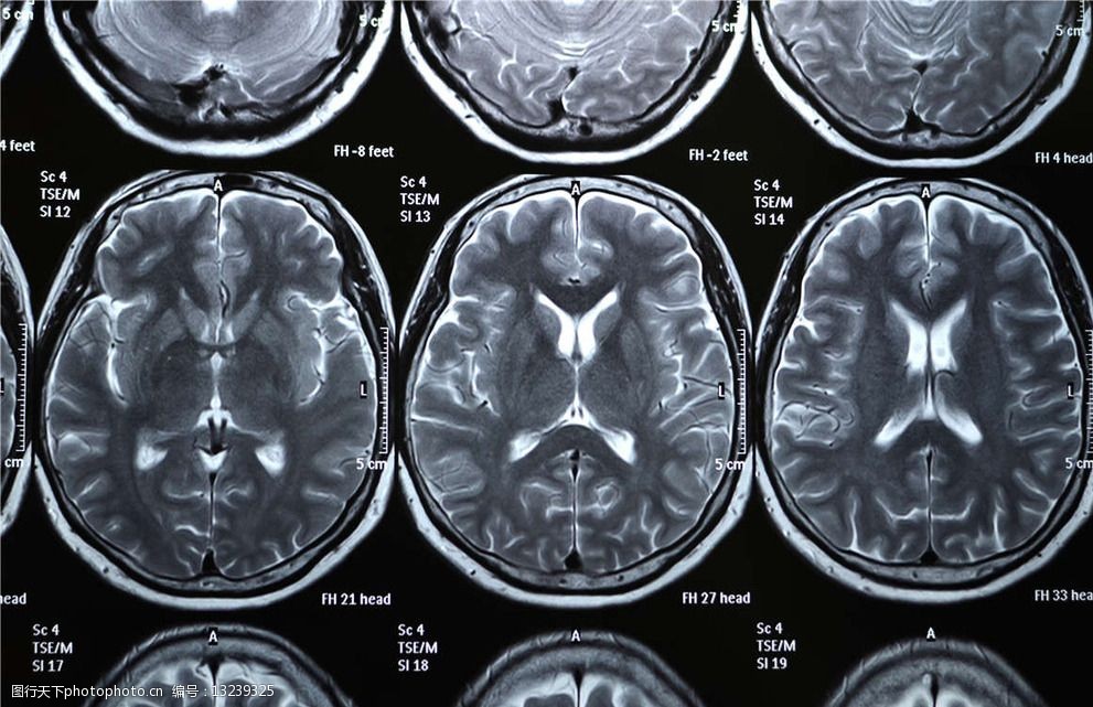 关键词:大脑x光片 大脑 x光 透视 医疗 ct x光片 核磁共振 医疗护理