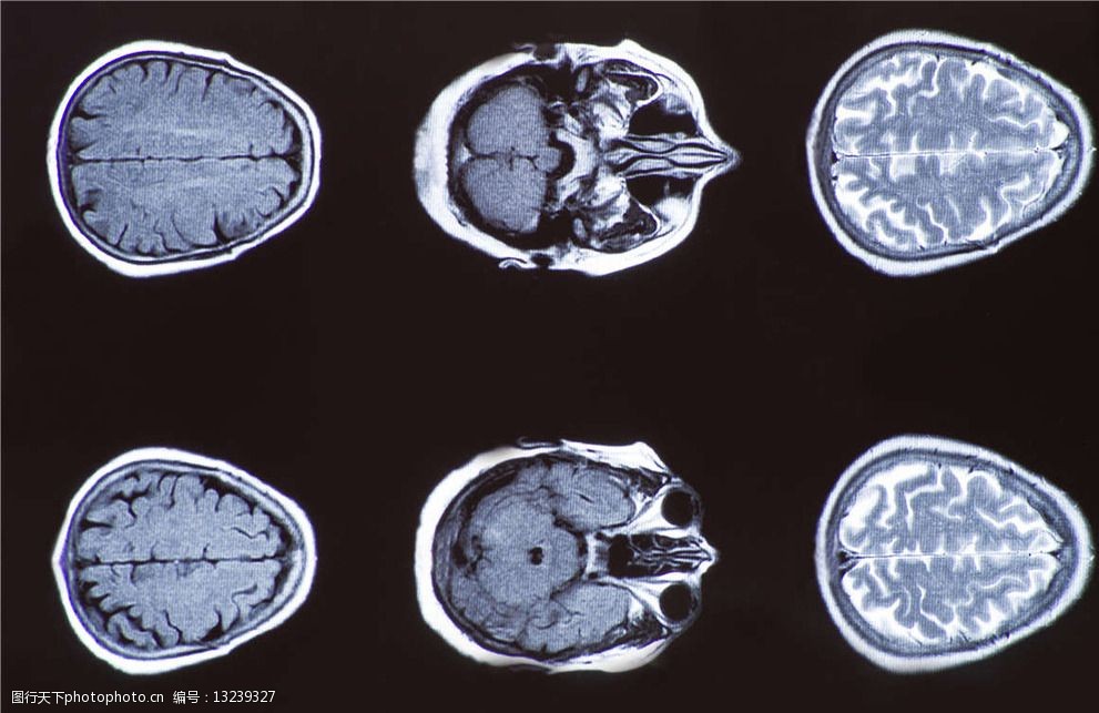 关键词:头部x光片 头部 大脑 x光 透视 医疗 ct x光片 核磁共振 医疗