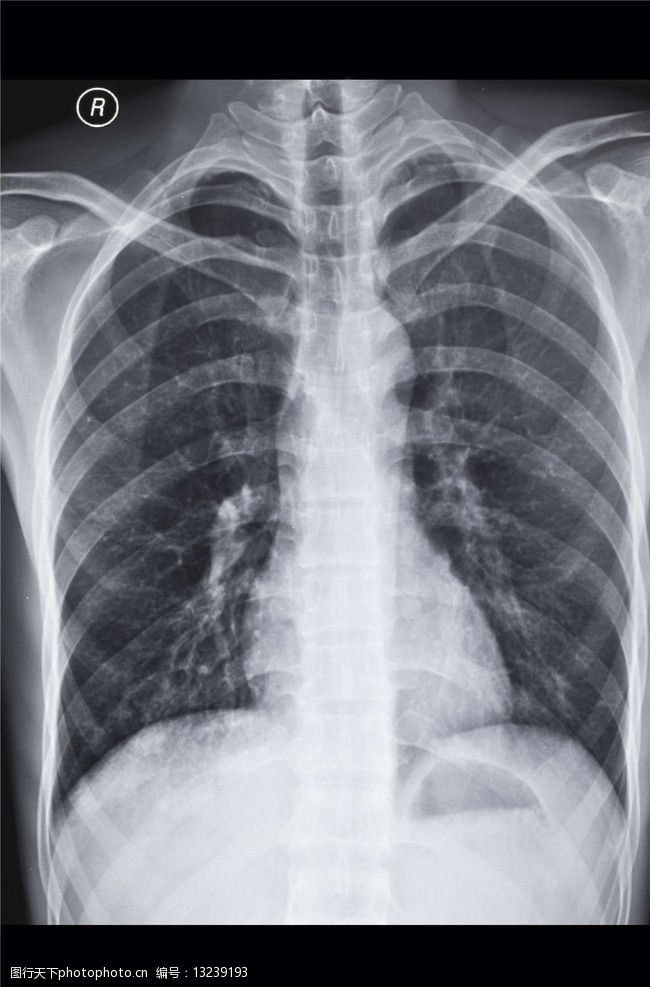 胸腔x光片图片